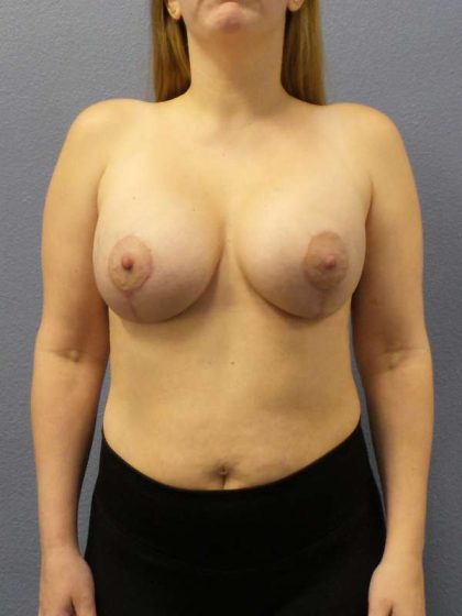 Breast Lift with Implant (Augmentation Mastopexy) Before & After Patient #4427