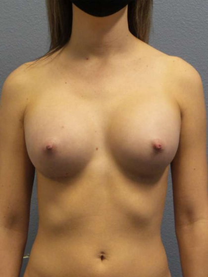 Breast Augmentation Before & After Patient #6457