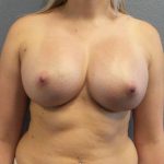 Breast Augmentation Before & After Patient #6919