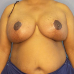 Mastopexy (Breast Lift) Before & After Patient #8402