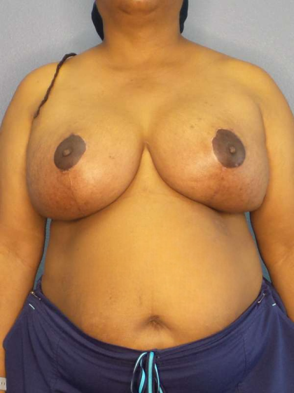 Mastopexy (Breast Lift) Before & After Patient #8402