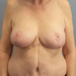 Mastopexy (Breast Lift) Before & After Patient #8377