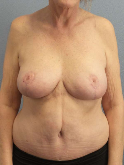 Mastopexy (Breast Lift) Before & After Patient #8377