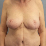 Breast Reduction Before & After Patient #7487