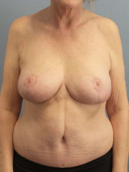Breast Reduction Before & After Patient #7487