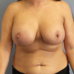 Asymmetric (Uneven) Breasts Before & After Patient #11149