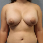 Breast Augmentation Before & After Patient #6826