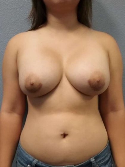 Breast Augmentation Before & After Patient #6826