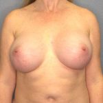 Breast Augmentation Before & After Patient #6364
