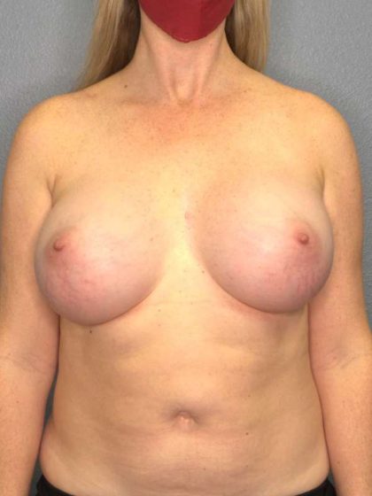 Breast Augmentation Before & After Patient #6364