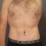Male Liposuction Before & After Patient #3808