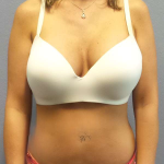 Liposuction Female Before & After Patient #8101