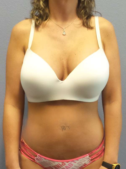 Liposuction Female Before & After Patient #8101