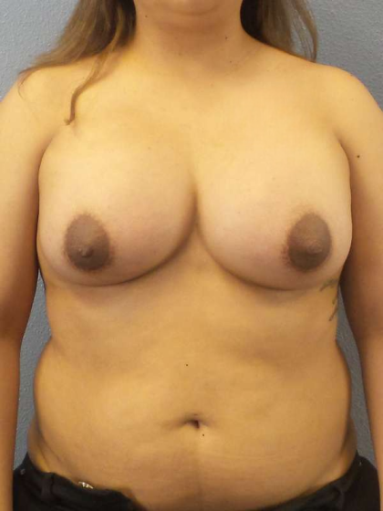 Breast Augmentation Before & After Patient #5626