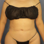 Liposuction Female Before & After Patient #8035