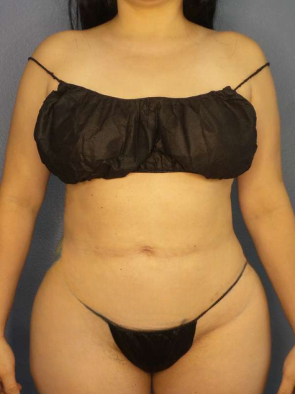 Liposuction Female Before & After Patient #8035