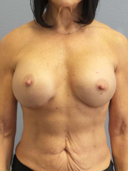 Breast Augmentation Revision (Breast Enlargement Repair) Before & After Patient #7291