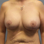 Breast Lift with Implant (Augmentation Mastopexy) Before & After Patient #4601