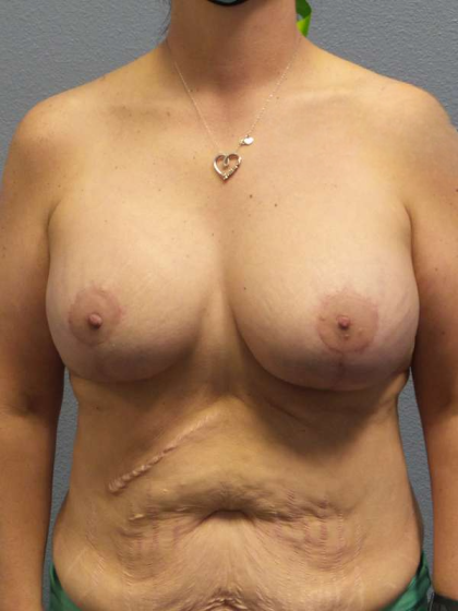 Breast Lift with Implant (Augmentation Mastopexy) Before & After Patient #4601