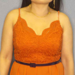 Liposuction Female Before & After Patient #7951