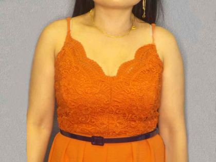 Liposuction Female Before & After Patient #7951