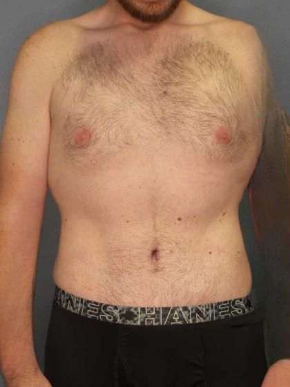 Male Liposuction Before & After Patient #3808