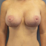 Breast Lift with Implant (Augmentation Mastopexy) Before & After Patient #4114