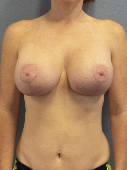 Breast Lift with Implant (Augmentation Mastopexy) Before & After Patient #4114