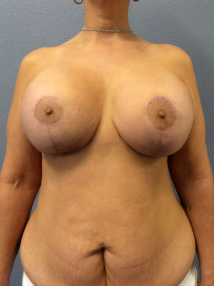 Breast Lift with Implant (Augmentation Mastopexy) Before & After Patient #4066
