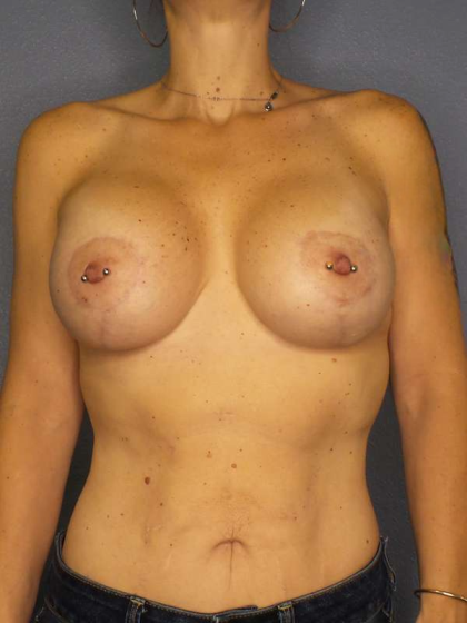 Breast Lift with Implant (Augmentation Mastopexy) Before & After Patient #3989