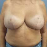 Breast Lift with Implant (Augmentation Mastopexy) Before & After Patient #3967