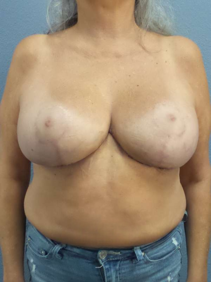 Breast Lift with Implant (Augmentation Mastopexy) Before & After Patient #3967