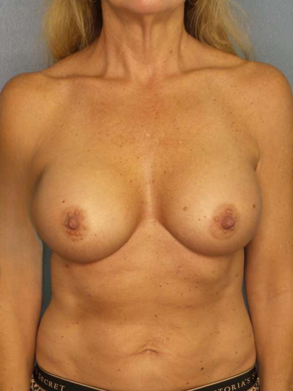 Breast Augmentation Before & After Patient #7056