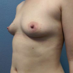 Breast Augmentation Before & After Patient #5706