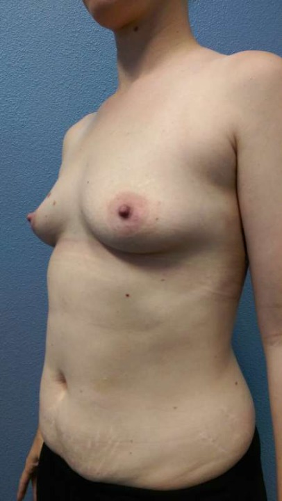 Breast Augmentation Before & After Patient #5706