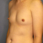 Breast Augmentation Before & After Patient #11573