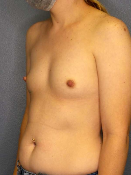 Breast Augmentation Before & After Patient #11573