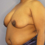 Mastopexy (Breast Lift) Before & After Patient #8402
