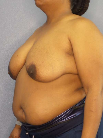 Mastopexy (Breast Lift) Before & After Patient #8402