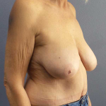 Mastopexy (Breast Lift) Before & After Patient #8377