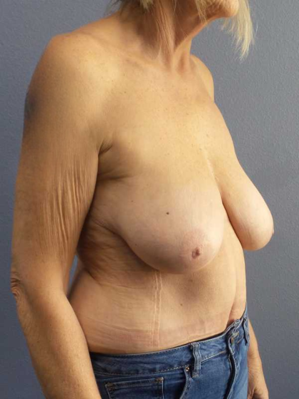 Mastopexy (Breast Lift) Before & After Patient #8377