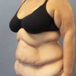 High BMI (Larger Patients) Surgery Before & After Patient #10393