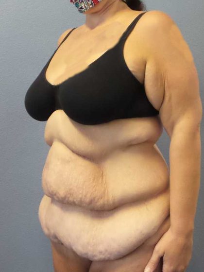 High BMI (Larger Patients) Surgery Before & After Patient #10393