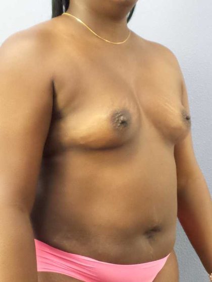 Breast Augmentation Before & After Patient #11436