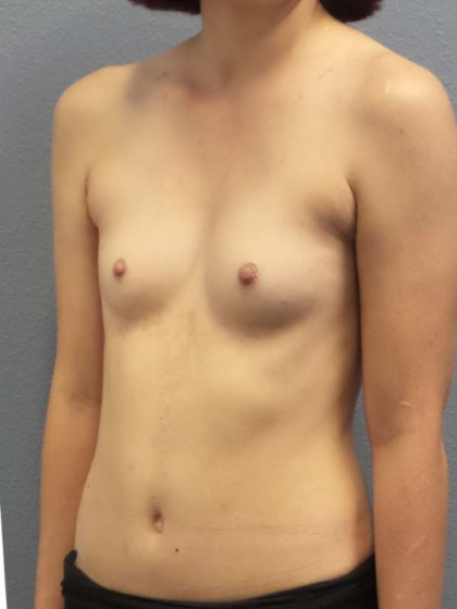 Breast Augmentation Before & After Patient #6760