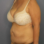 High BMI (Larger Patients) Surgery Before & After Patient #10438