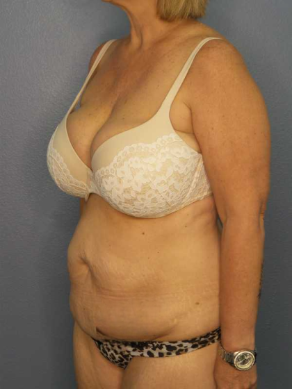 High BMI (Larger Patients) Surgery Before & After Patient #10438