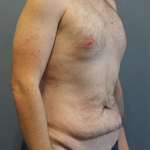 Male Liposuction Before & After Patient #3808