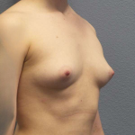 Breast Augmentation Before & After Patient #5296