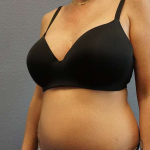 Liposuction Female Before & After Patient #8101